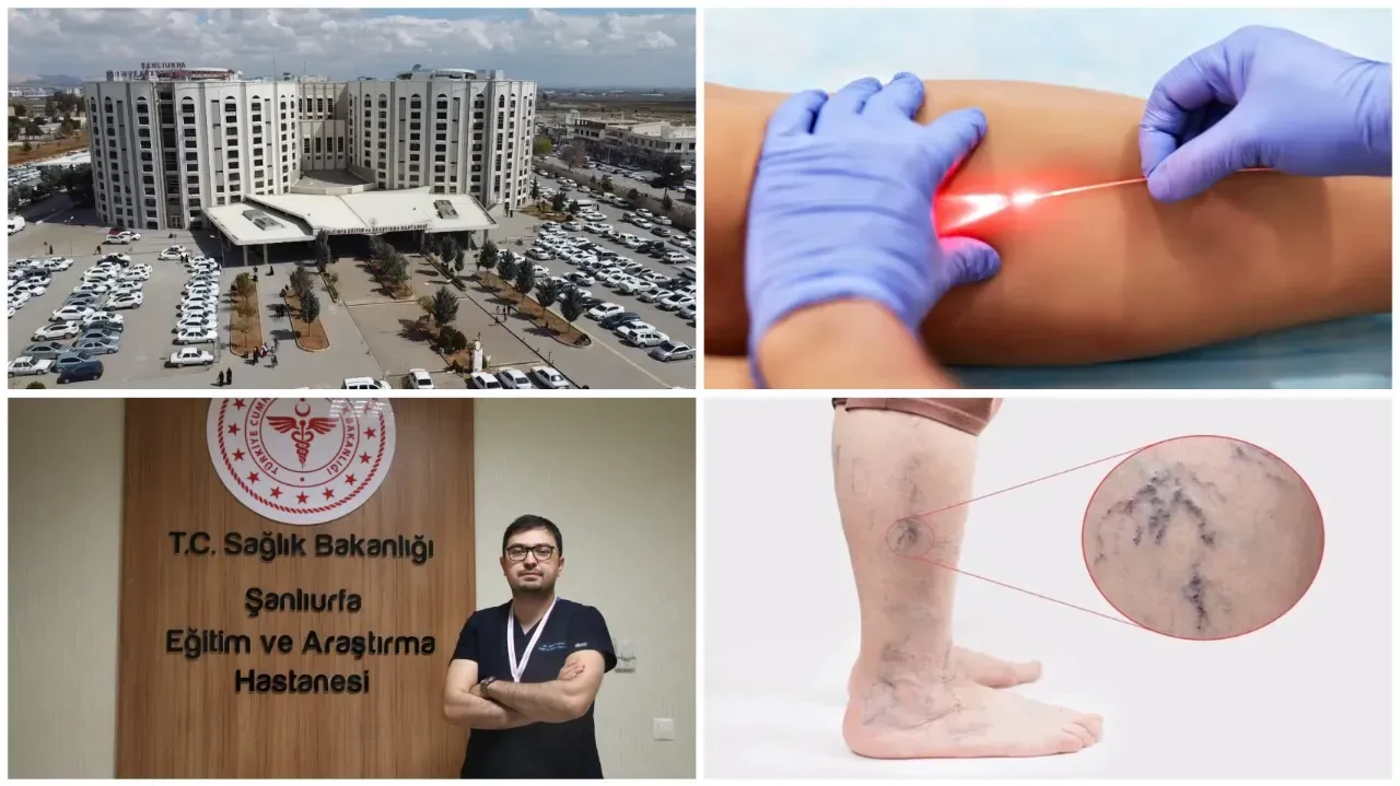 Şanlıurfa’da Varis Tedavisinde Ameliyatsız Dönem